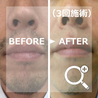 Before After